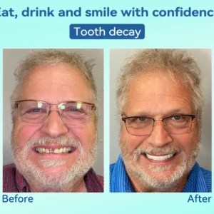 🌎Ends Today: 70% OFF!⏰Tiworld® Premium Denture🍀AdaptableFit Functional Dentures🦷Obtain American Dental Association (ADA) Certification