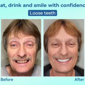 🌎Ends Today: 70% OFF!⏰Tiworld® Premium Denture🍀AdaptableFit Functional Dentures🦷Obtain American Dental Association (ADA) Certification