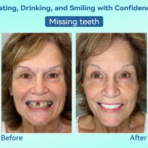 🌎Ends Today: 70% OFF!⏰Tiworld® Premium Denture🍀AdaptableFit Functional Dentures🦷Obtain American Dental Association (ADA) Certification