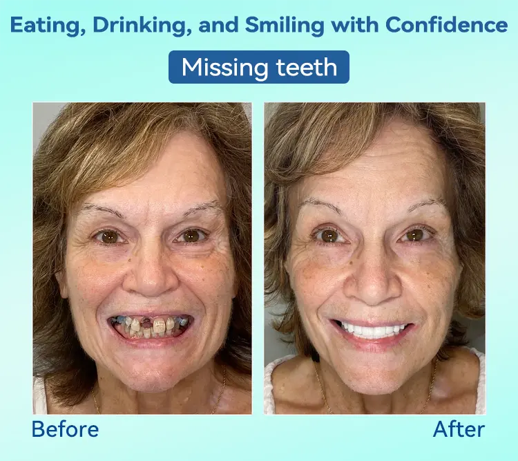 🌎Ends Today: 70% OFF!⏰Tiworld® Premium Denture🍀AdaptableFit Functional Dentures🦷Obtain American Dental Association (ADA) Certification