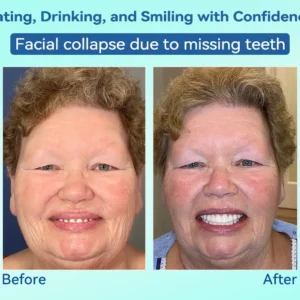 🌎Ends Today: 70% OFF!⏰Tiworld® Premium Denture🍀AdaptableFit Functional Dentures🦷Obtain American Dental Association (ADA) Certification