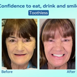 🌎Ends Today: 70% OFF!⏰Tiworld® Premium Denture🍀AdaptableFit Functional Dentures🦷Obtain American Dental Association (ADA) Certification