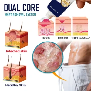 Tiworld® Genital Warts Remover Cream 👨 Specially Formulated for Men