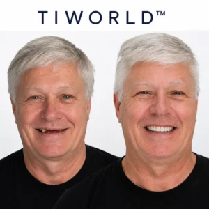 💖 🦷 TIWORLD™ Custom-Fit Dentures ⏰ ENDS TODAY 70% OFF | Smile with Confidence