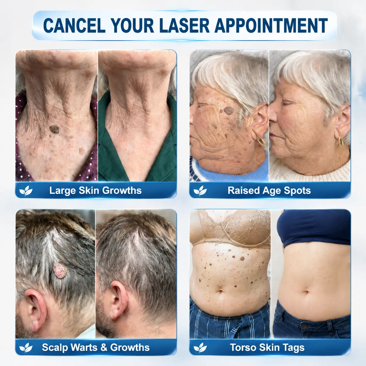 FDA Registered Facility | Tiworld® 7-Day Skin Tag & Spot Eraser Painle
– camelleshop