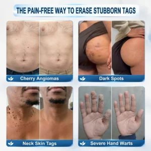FDA Registered Facility | Tiworld® 7-Day Skin Tag & Spot Eraser Painle
– camelleshop