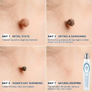FDA Registered Facility | Tiworld® 7-Day Skin Tag & Spot Eraser Painle
– camelleshop