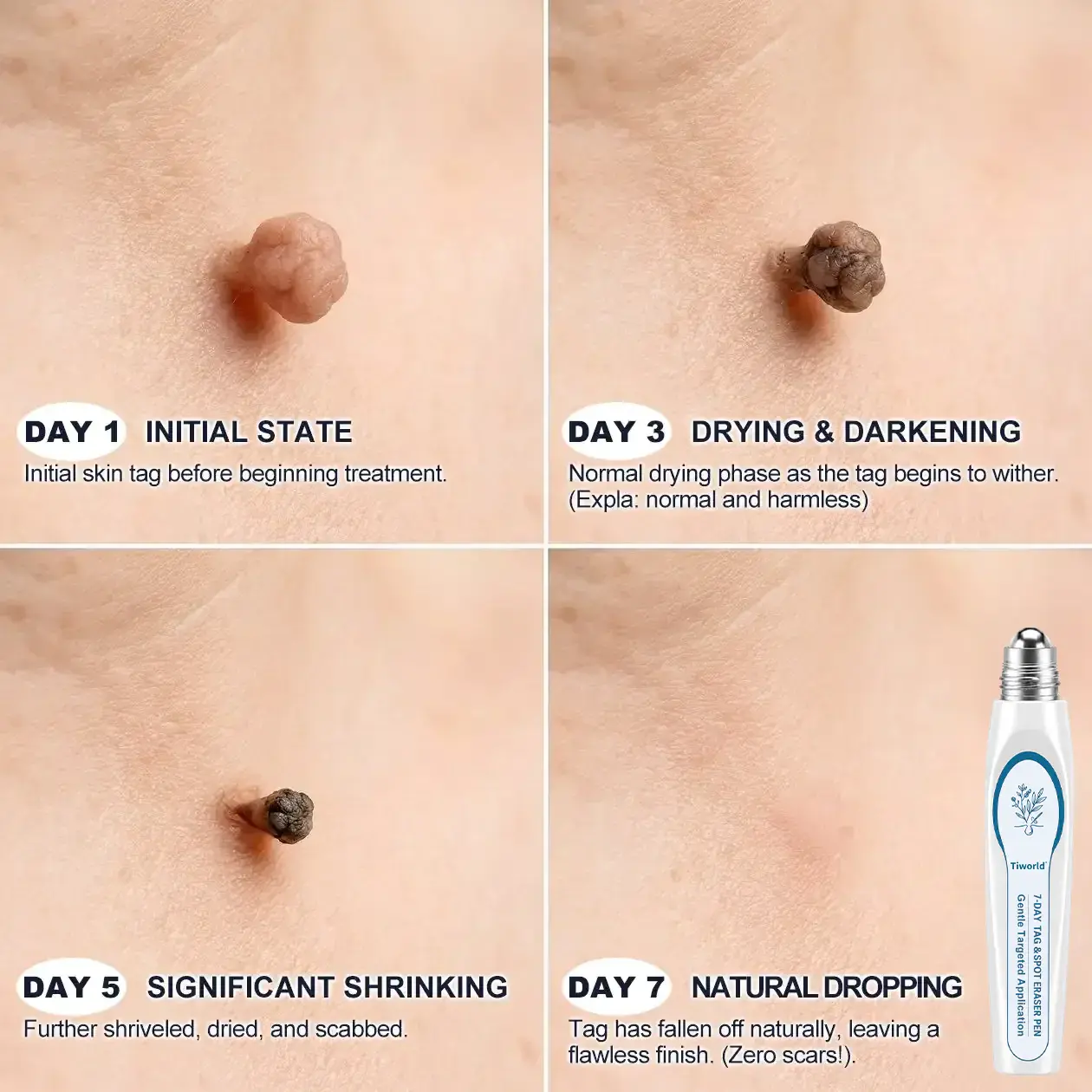 FDA Registered Facility | Tiworld® 7-Day Skin Tag & Spot Eraser Painle
– camelleshop