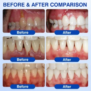 👨‍⚕️🦷🛡️Tiworld ® Gum health Periodontal Repair Gel