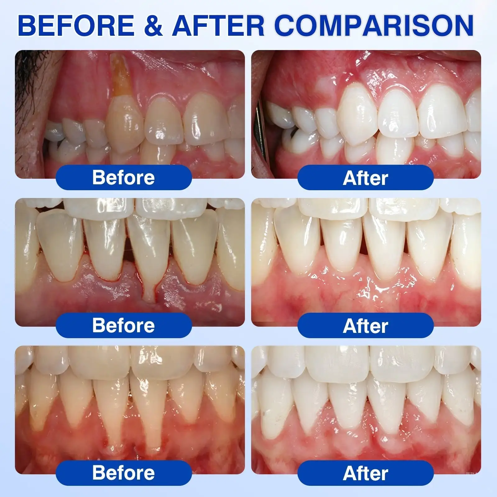 👨⚕️🦷🛡️Tiworld ® Gum health Periodontal Repair Gel