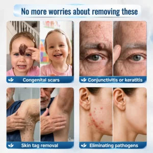 Tiworld® Advanced Corrective Cream for Skin Tags, Moles & Spots – 7-Day Painless, Scar-Free Care for Visible Skin Imperfections