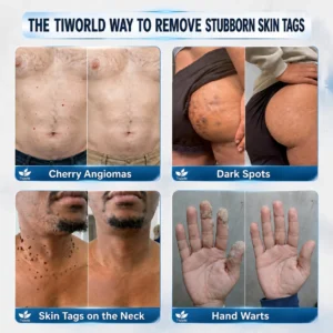 Tiworld® Advanced Corrective Cream for Skin Tags, Moles & Spots – 7-Day Painless, Scar-Free Care for Visible Skin Imperfections
