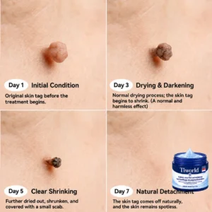 Tiworld® Advanced Corrective Cream for Skin Tags, Moles & Spots – 7-Day Painless, Scar-Free Care for Visible Skin Imperfections
