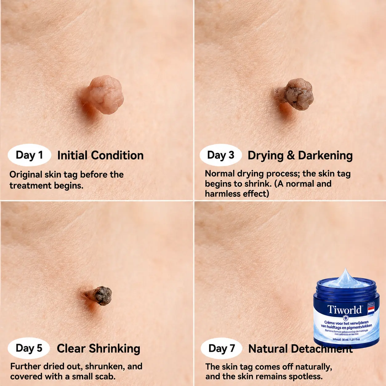Tiworld® Advanced Corrective Cream for Skin Tags, Moles & Spots – 7-Day Painless, Scar-Free Care for Visible Skin Imperfections