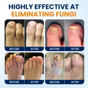 Tiworld® Nail fungus relief spray