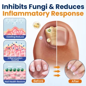 Tiworld® Nail fungus relief spray
