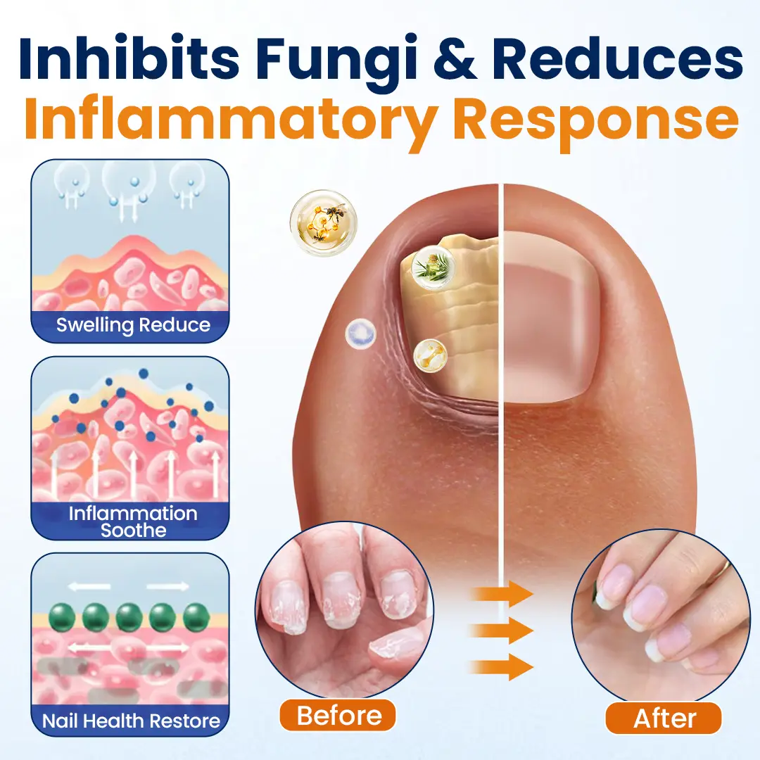 Tiworld® Nail fungus relief spray