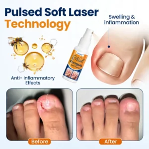 Tiworld® Nail fungus relief spray