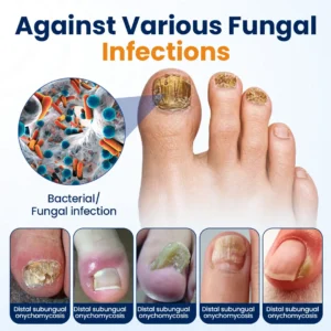 Tiworld® Nail fungus relief spray