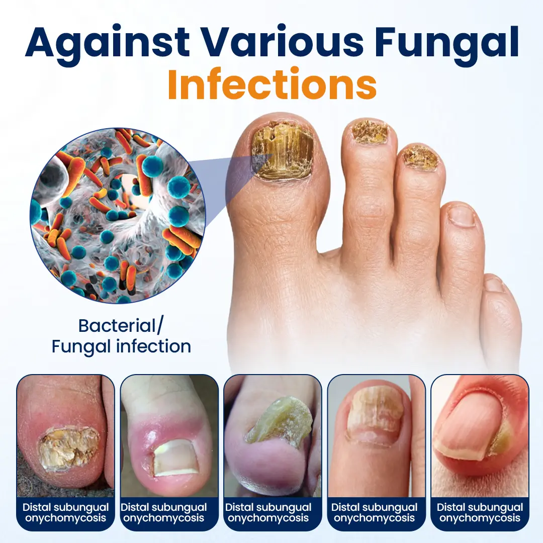 Tiworld® Nail fungus relief spray